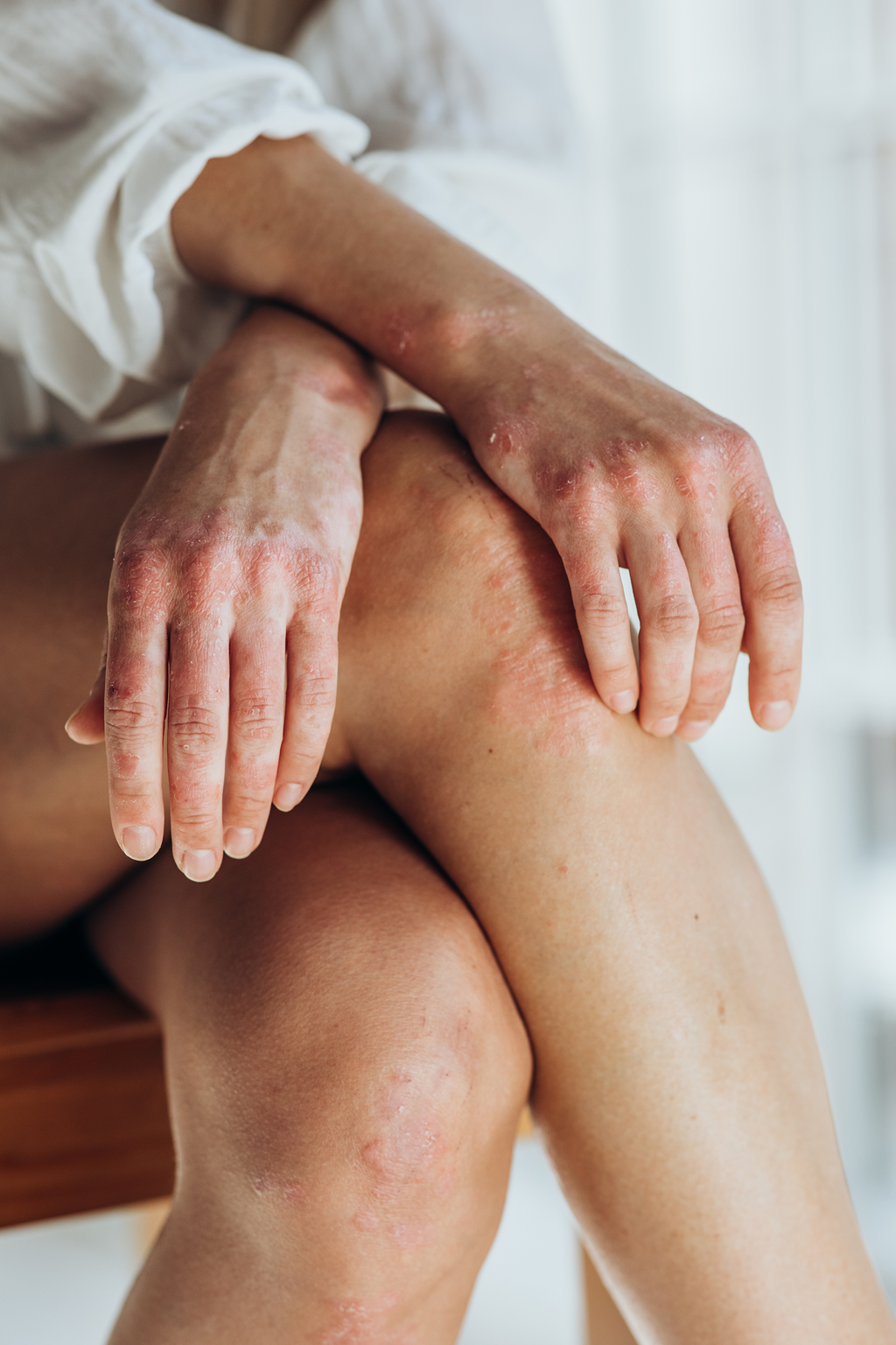 Balm the Eczema