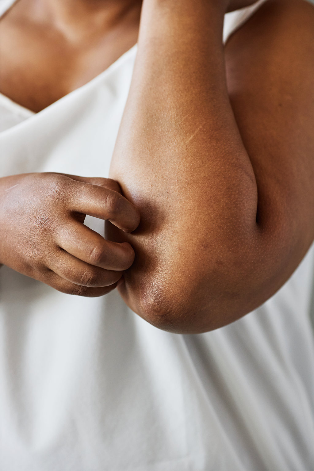 A lady scratching dry elbow skin.